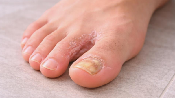 athlete's foot between toes