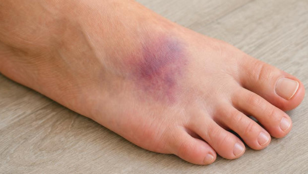 Bruise on top of foot with visible discoloration and swelling