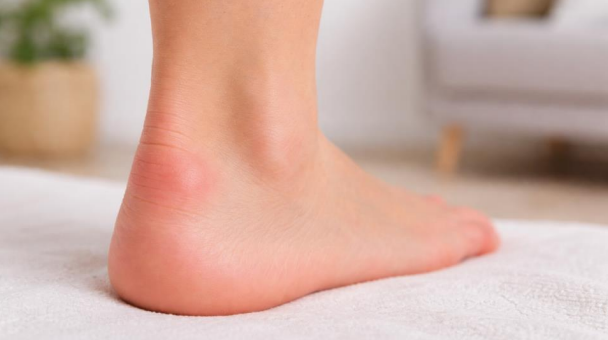 Bump on back of heel with swelling near Achilles tendon
