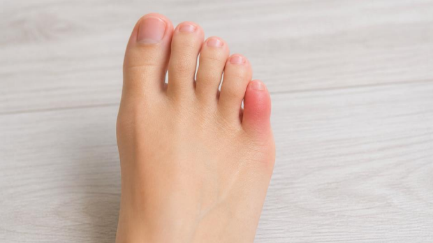 Pinky toe pain with redness and swelling on outer foot