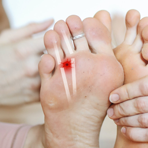 Illustration showing a neuroma causing nerve pain between the metatarsal bones.