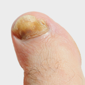 Discolored and thickened toenail caused by fungal infection.