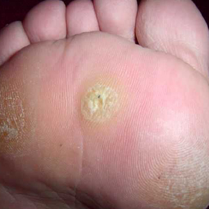 Plantar wart on the bottom of the foot.
