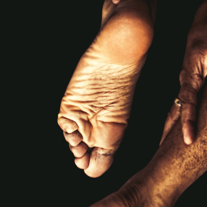Signs of athlete's foot affecting the toes and sole.