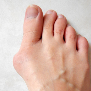 Bunion deformity affecting the joint of the big toe.