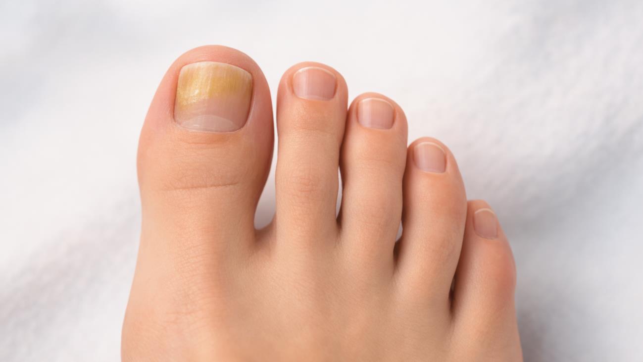 Mild toenail fungus on big toe showing yellow discoloration