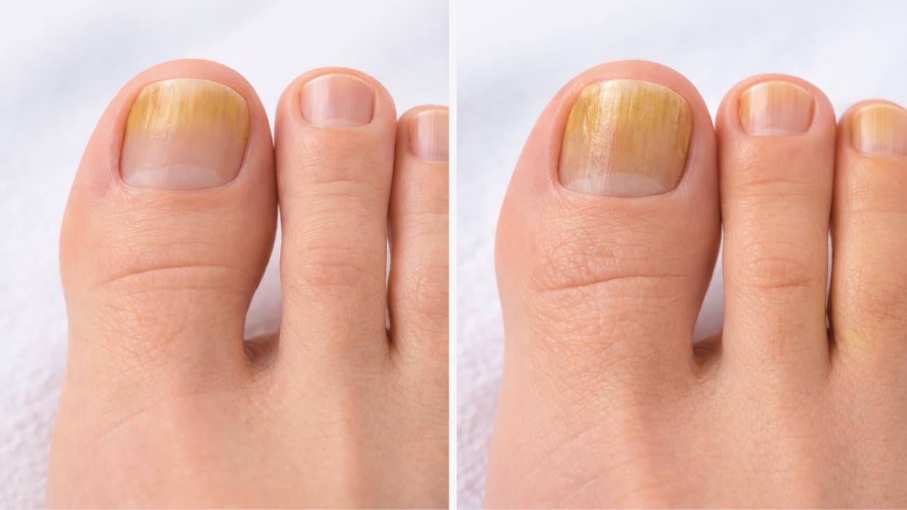 Toenail fungus progression from mild to advanced stages