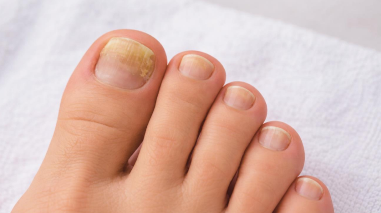 toenail fungus symptoms