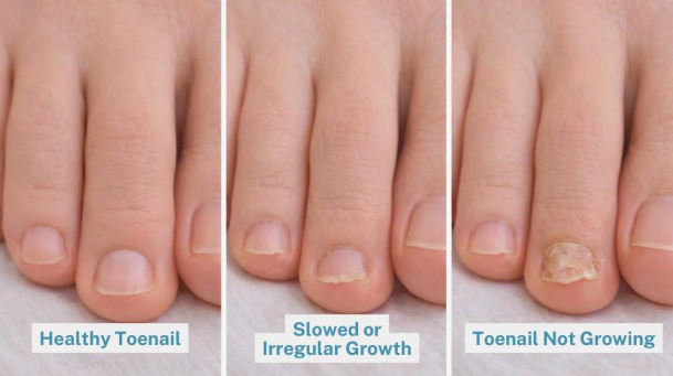 Toenail not growing comparison showing healthy and abnormal nail growth
