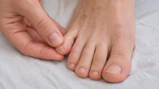 Toenail not growing with person examining damaged toenail