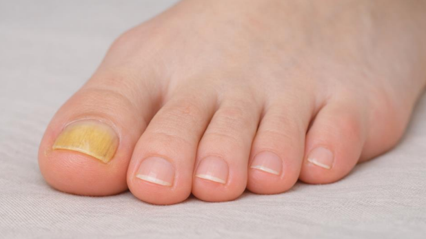 Yellow big toenail showing discoloration commonly seen with yellowing toenails